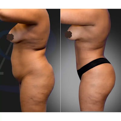 Liposuction Before & After Gallery - Patient 239241 - Image 1