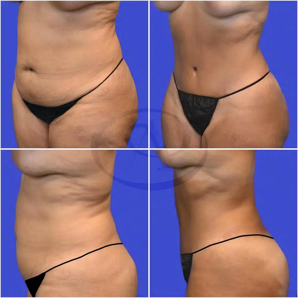 Tummy Tuck Before & After Gallery - Patient 140734 - Image 1