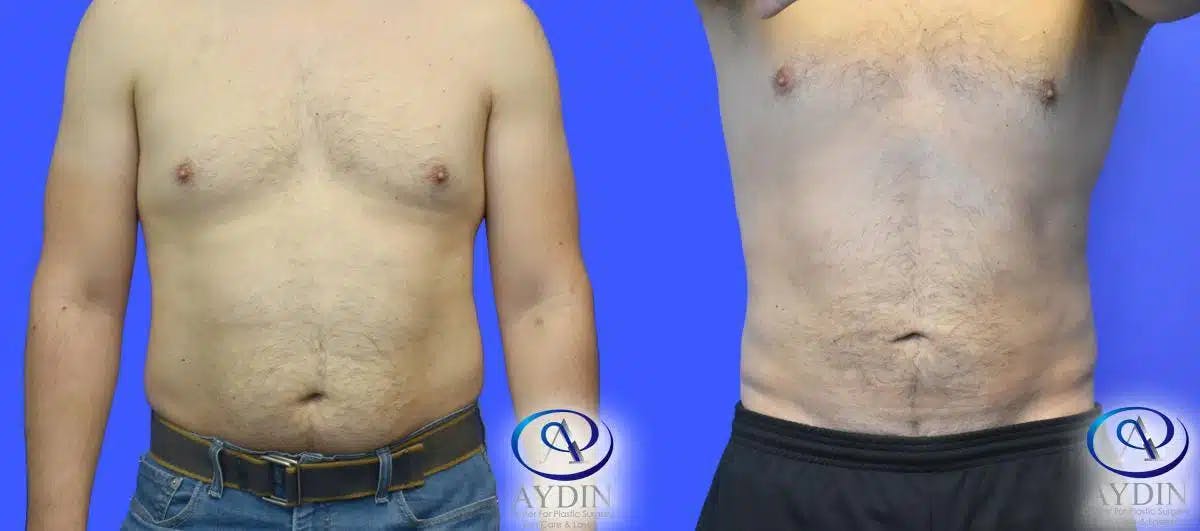 Male Liposuction Before & After Gallery - Patient 188556 - Image 1
