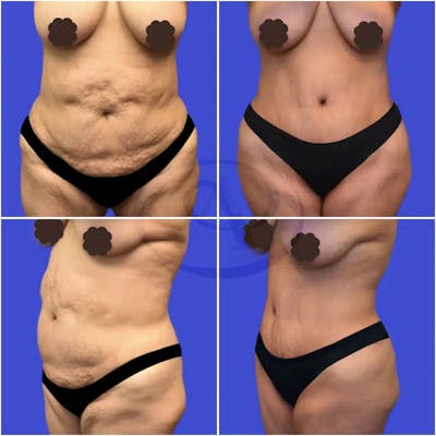 Tummy Tuck Before & After Gallery - Patient 389432 - Image 1