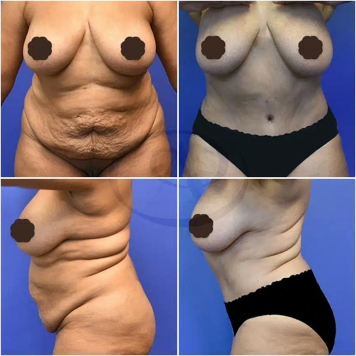 Tummy Tuck Before & After Gallery - Patient 122162 - Image 1