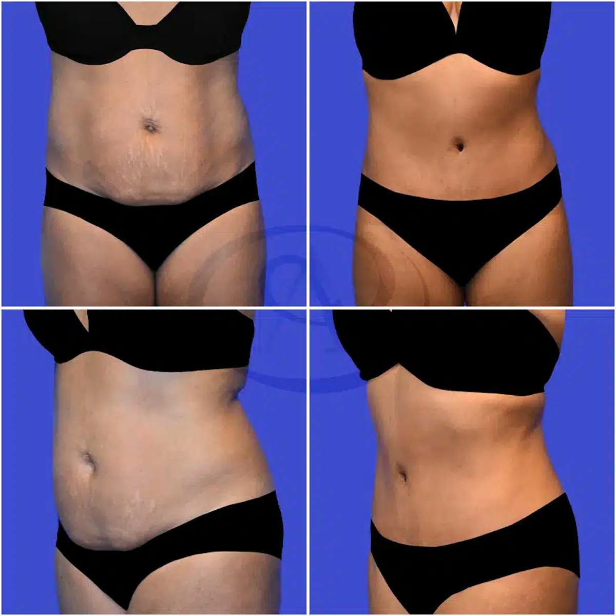 Tummy Tuck Before & After Gallery - Patient 967922 - Image 1