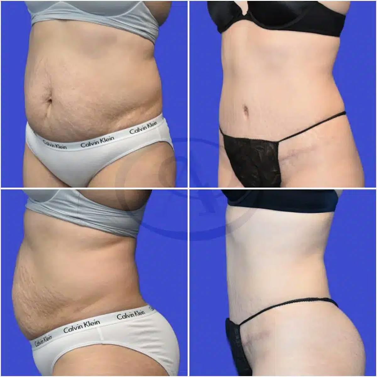 Tummy Tuck Before & After Gallery - Patient 200896 - Image 1