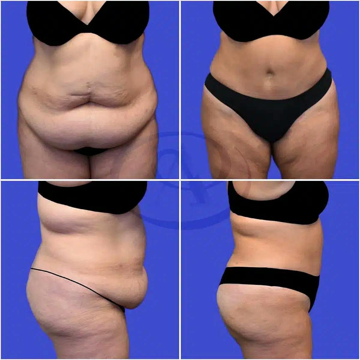 Tummy Tuck Before & After Gallery - Patient 399197 - Image 1
