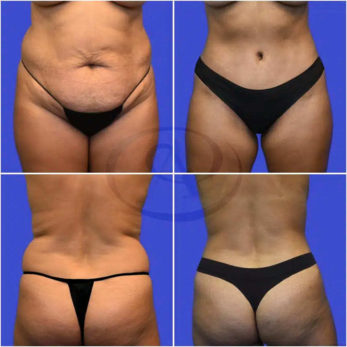 Tummy Tuck Before & After Gallery - Patient 123446 - Image 1