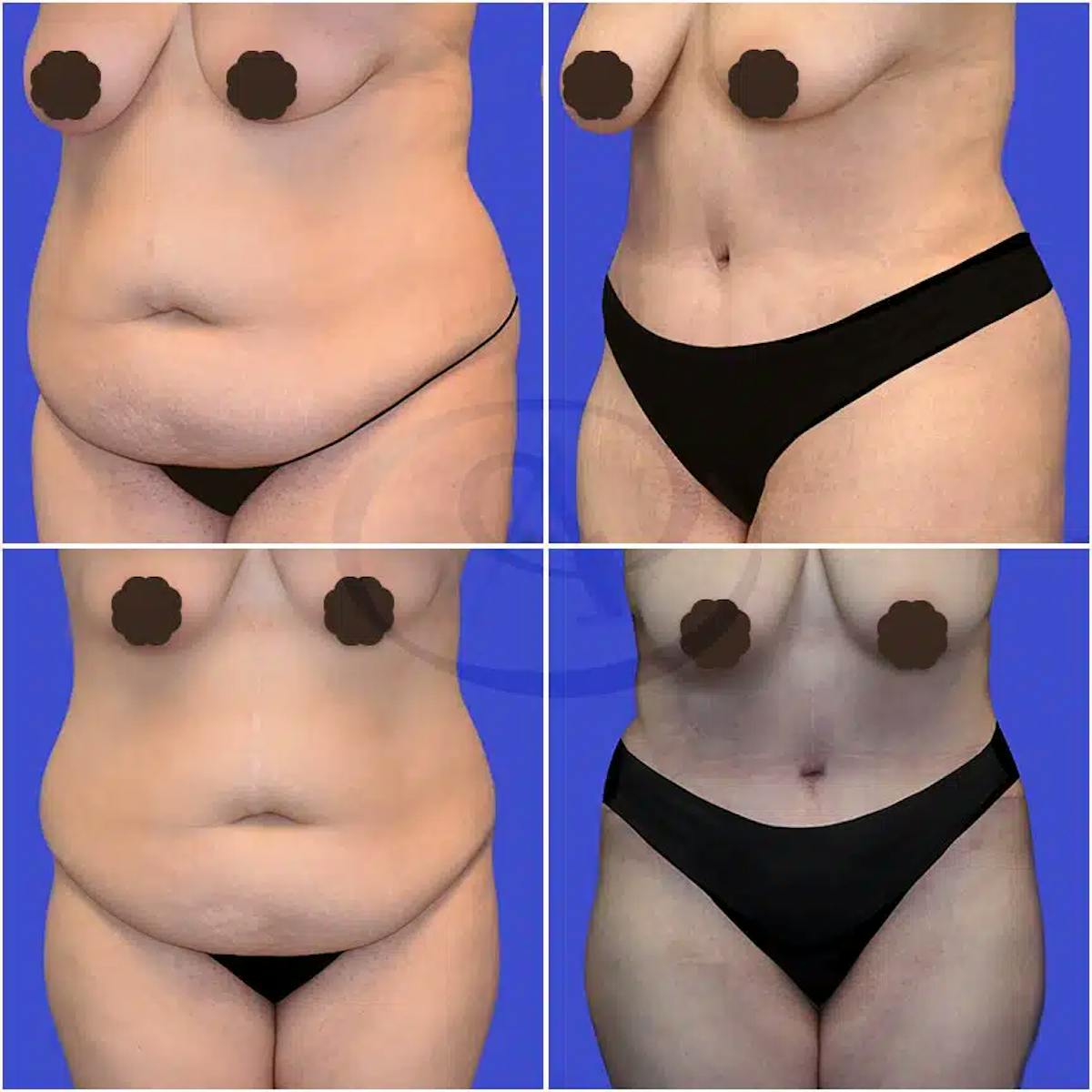 Tummy Tuck Before & After Gallery - Patient 659348 - Image 1