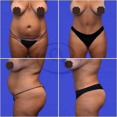 Tummy Tuck Before & After Gallery - Patient 349802 - Image 1