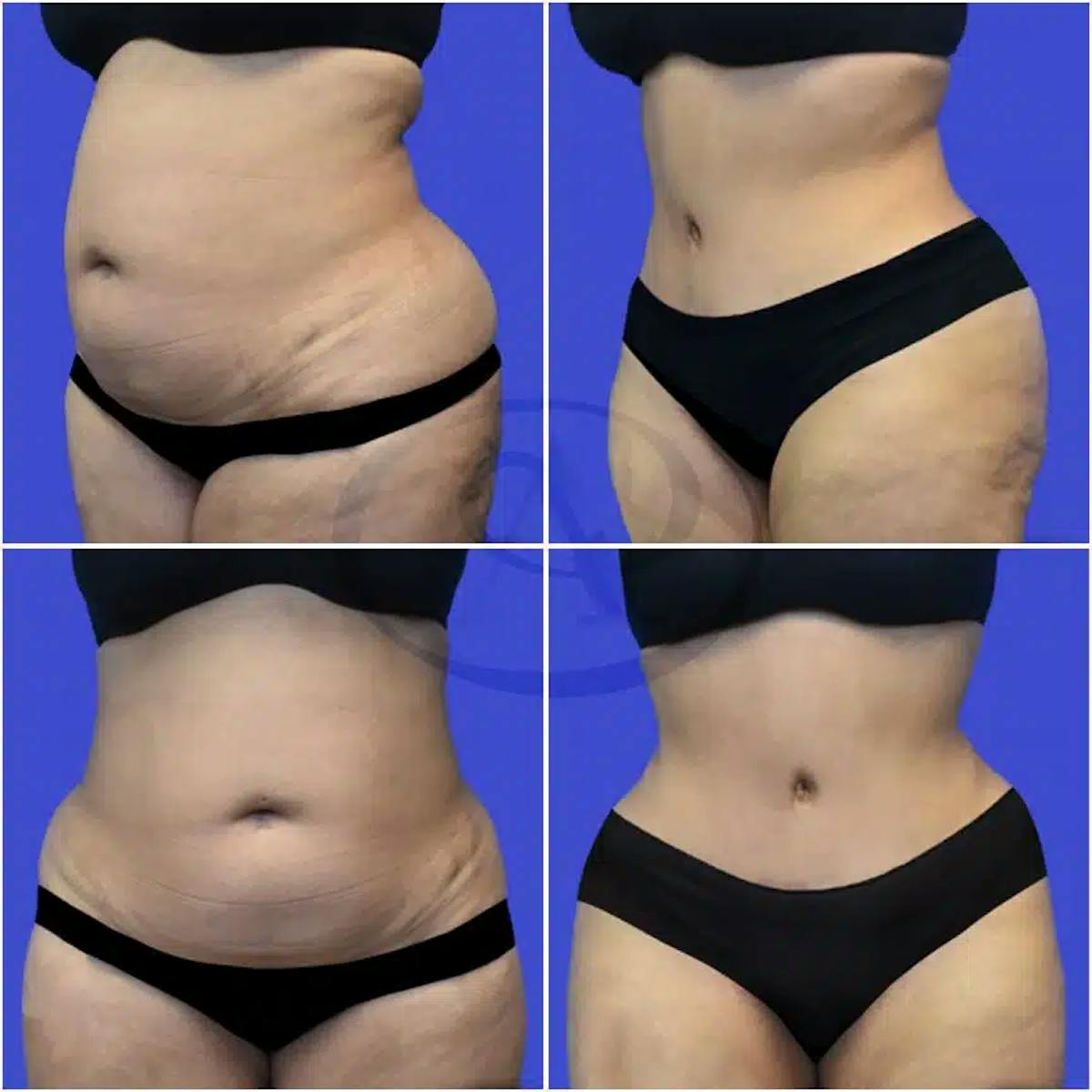 Tummy Tuck Before & After Gallery - Patient 220110 - Image 1