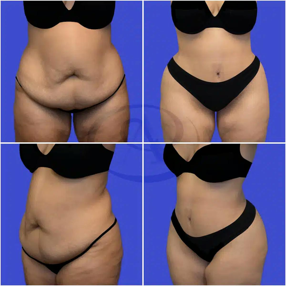 Tummy Tuck Before & After Gallery - Patient 360114 - Image 1