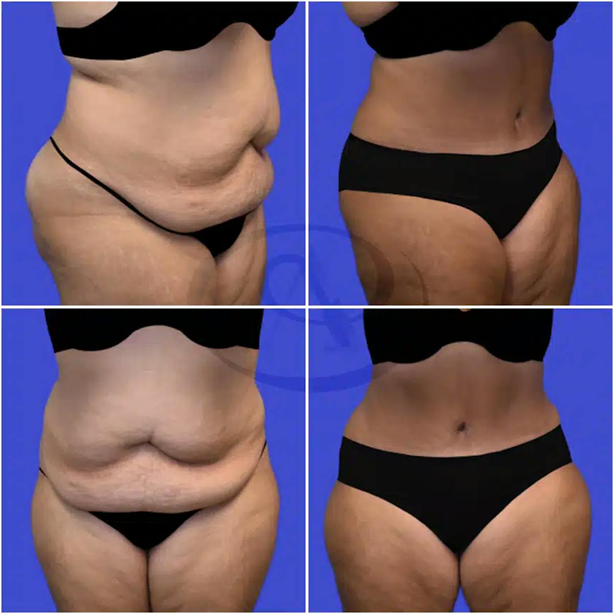 Tummy Tuck Before & After Gallery - Patient 981700 - Image 1