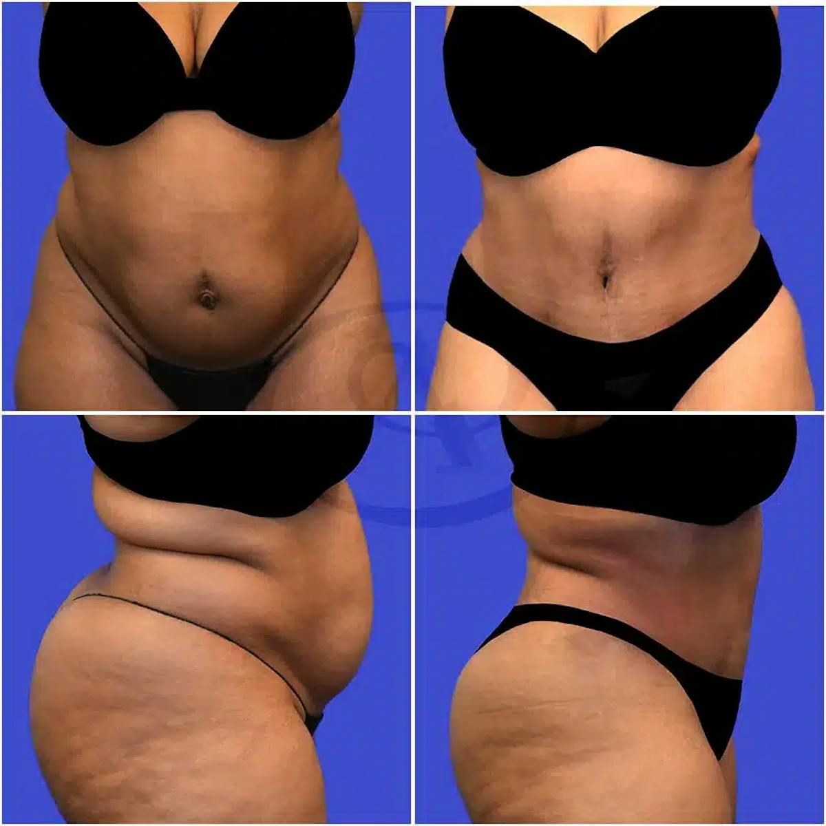 Tummy Tuck Before & After Gallery - Patient 336395 - Image 1