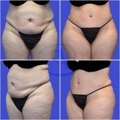 Tummy Tuck Before & After Gallery - Patient 166927 - Image 1