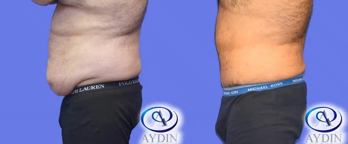 Male Tummy Tuck  Before & After Gallery - Patient 286678 - Image 1