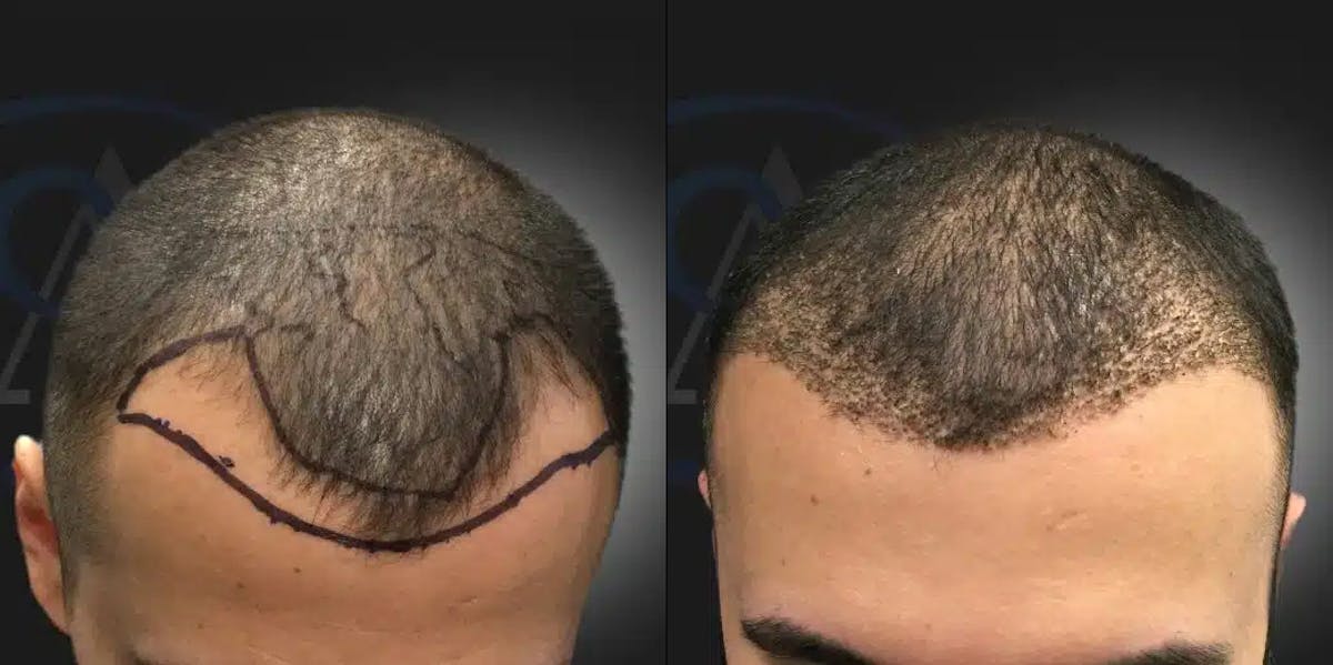NeoGraft Hair Restoration® Before & After Gallery - Patient 181412 - Image 1