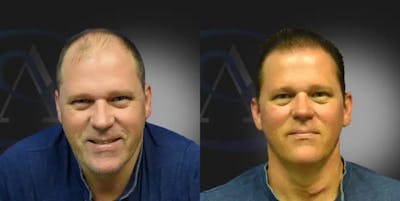 NeoGraft Hair Restoration® Before & After Gallery - Patient 152506 - Image 1