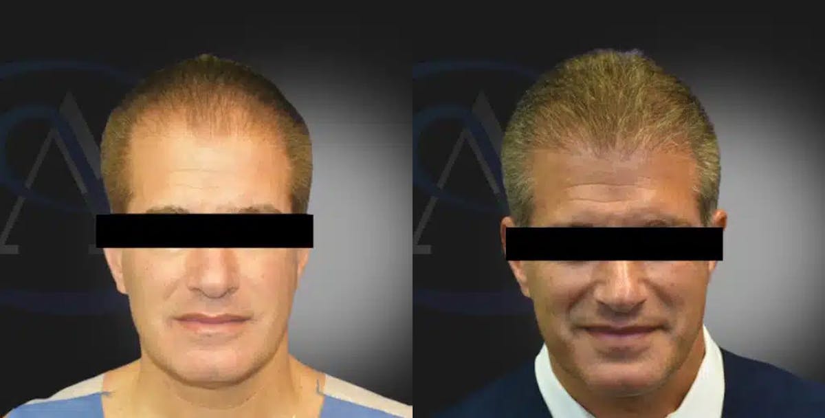 NeoGraft Hair Restoration® Before & After Gallery - Patient 112410 - Image 1