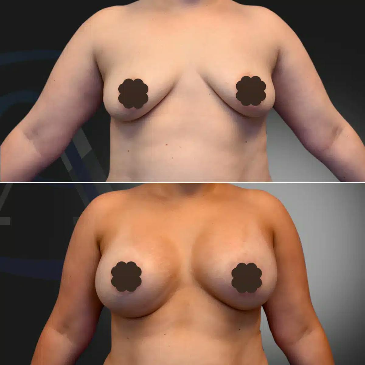 Breast Augmentation Before & After Gallery - Patient 308506 - Image 1