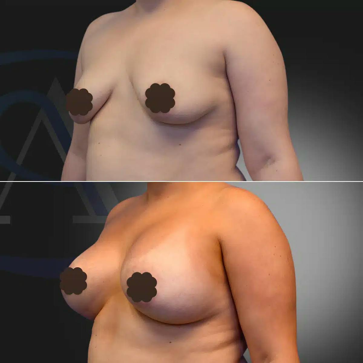 Breast Augmentation Before & After Gallery - Patient 308506 - Image 2