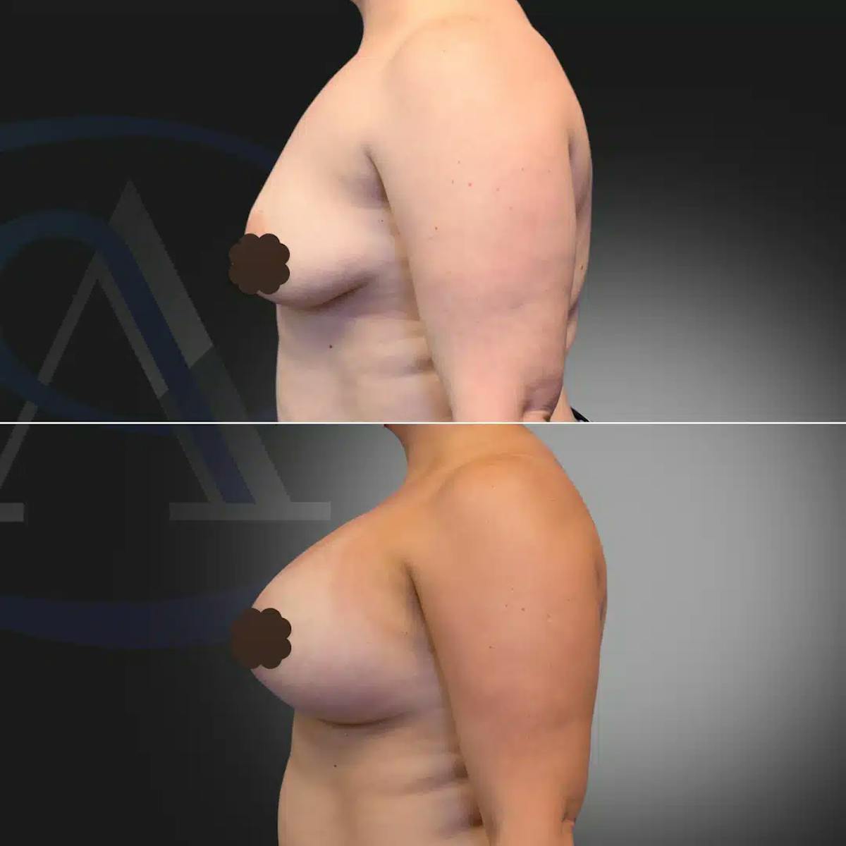 Breast Augmentation Before & After Gallery - Patient 308506 - Image 3