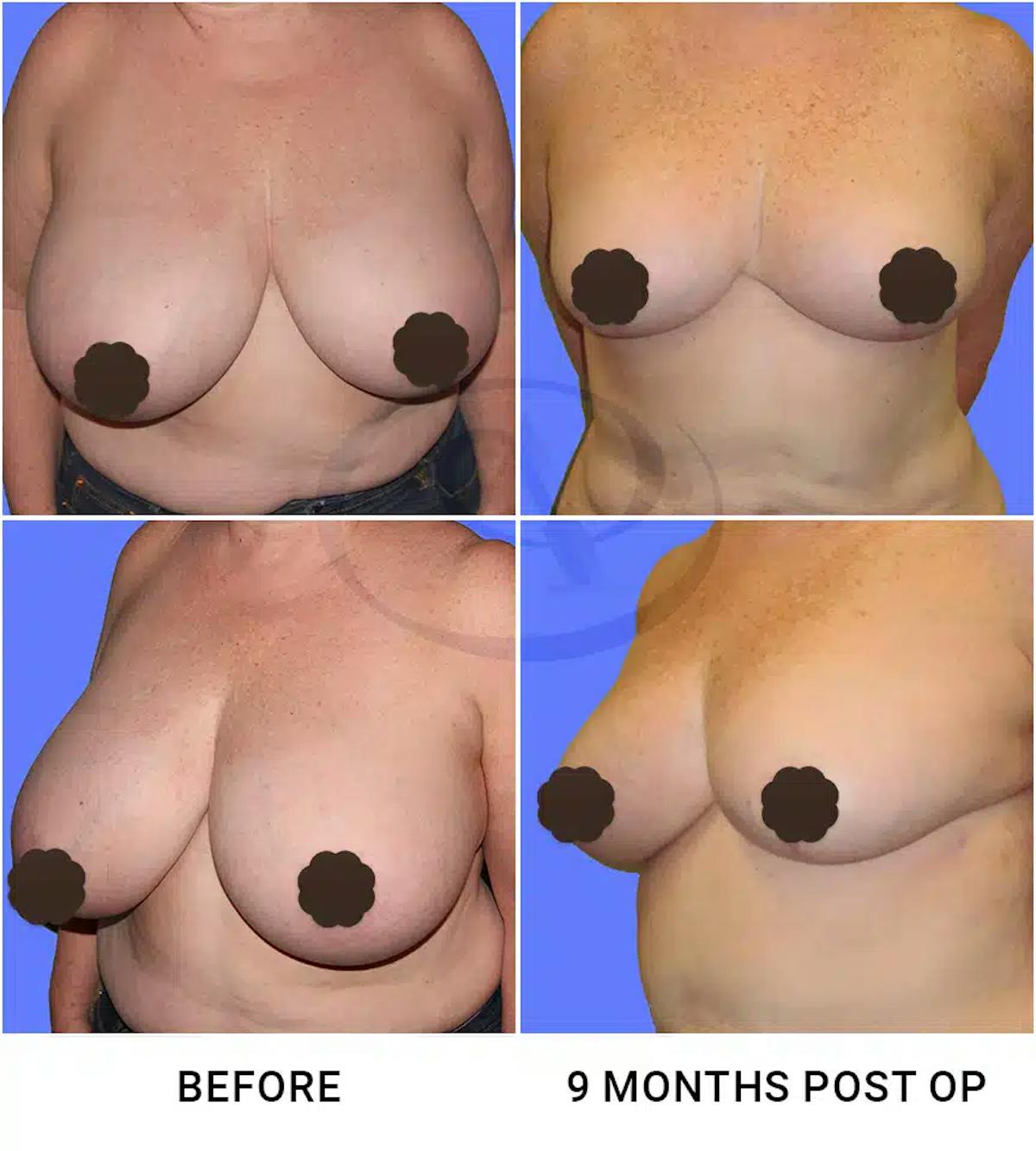 Breast Reduction Before & After Gallery - Patient 392965 - Image 1
