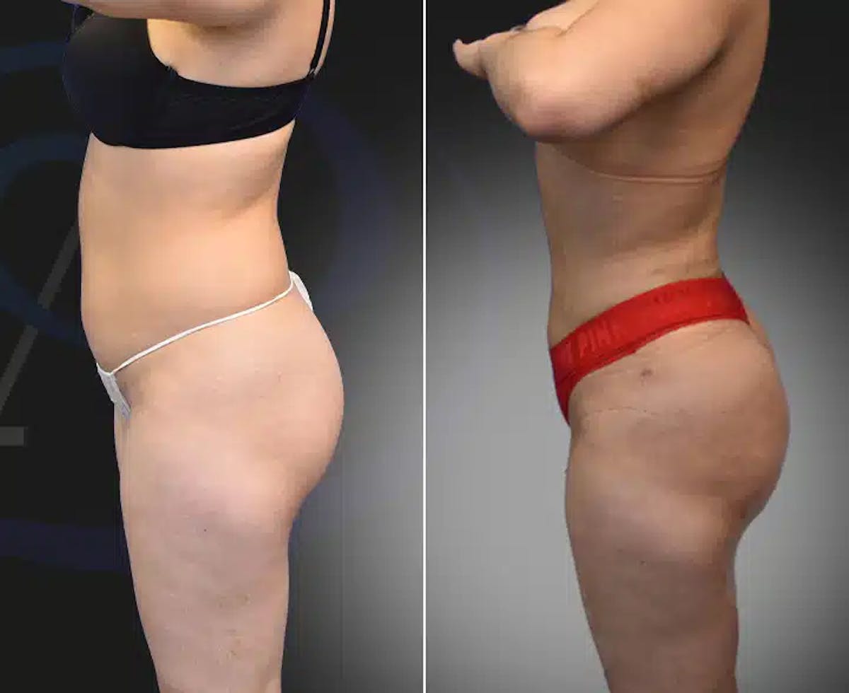 Brazilian Butt Lift Before & After Gallery - Patient 295439 - Image 2