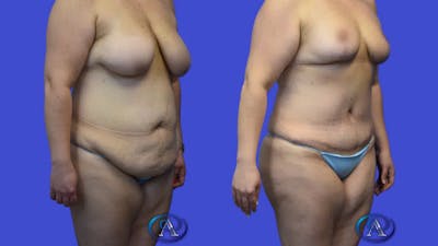 Mommy Makeover Before & After Gallery - Patient 377945 - Image 1