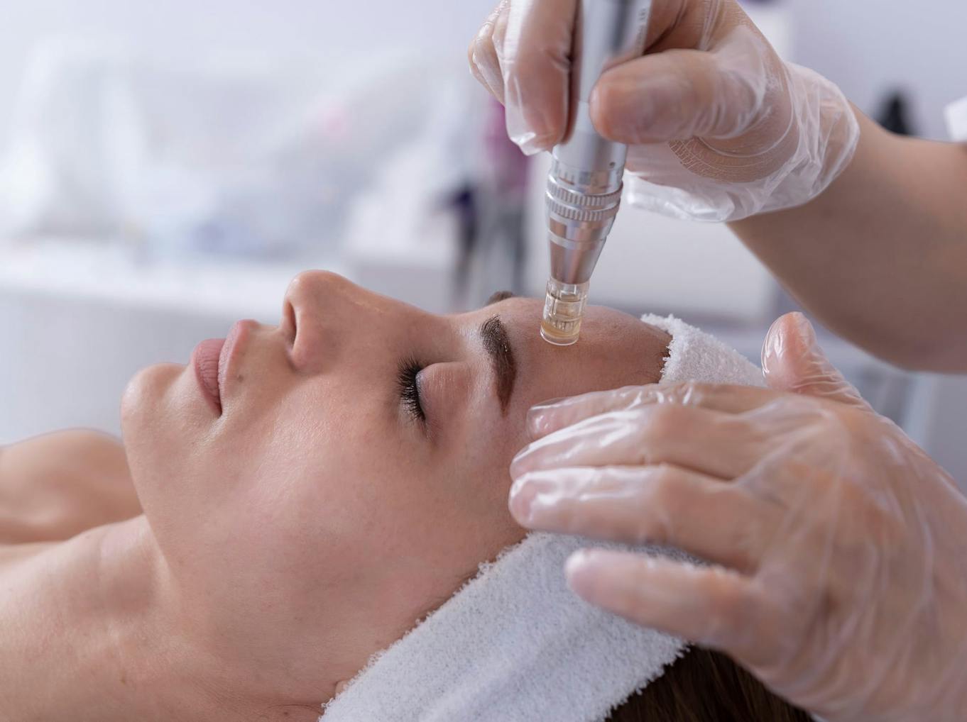 Woman getting microneedling treatment