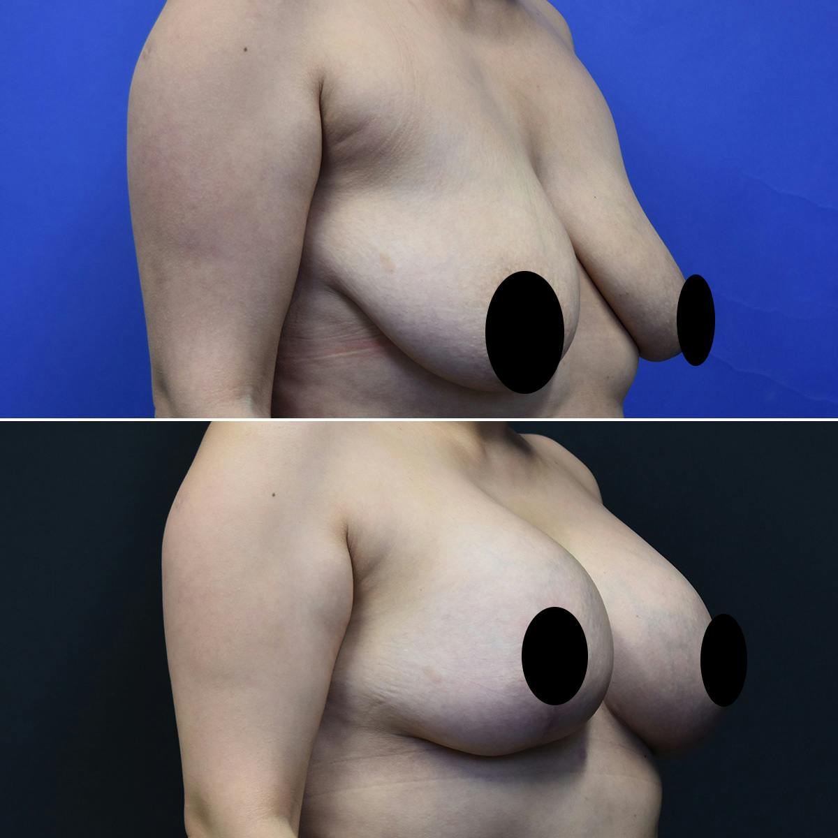 Tummy Tuck Before & After Gallery - Patient 239810 - Image 2