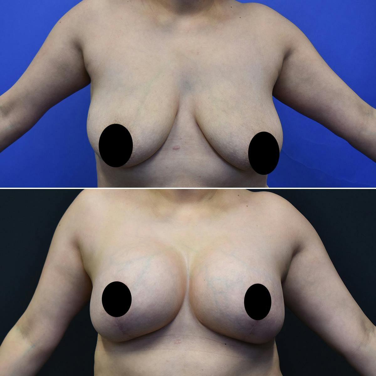 Breast Lift Before & After Gallery - Patient 301011 - Image 1