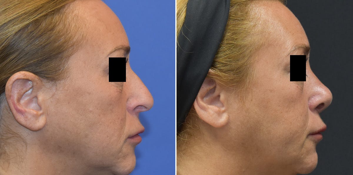 Rhinoplasty Before & After Gallery - Patient 247058 - Image 3