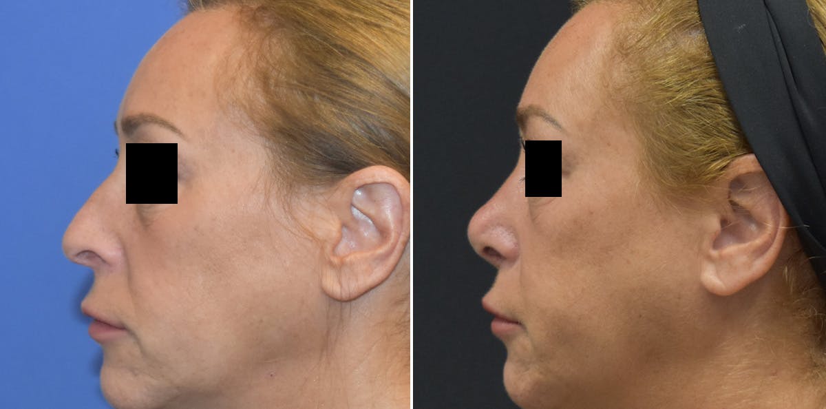 Rhinoplasty Before & After Gallery - Patient 247058 - Image 1