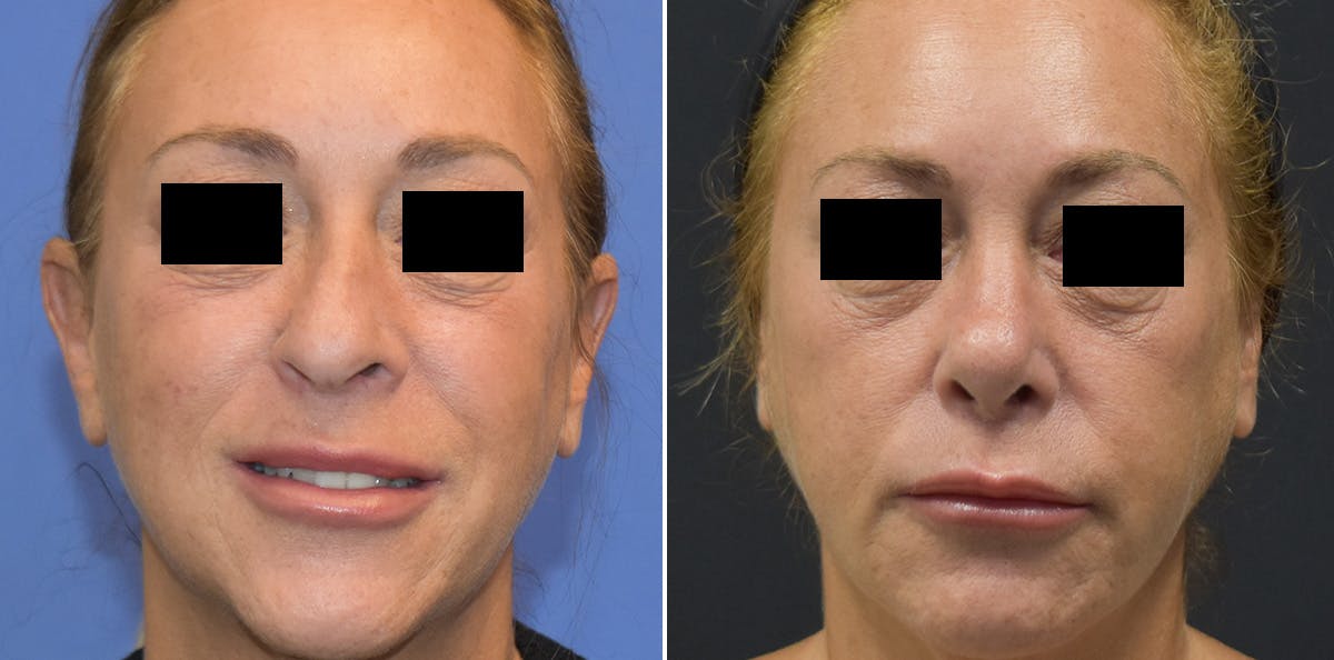 Rhinoplasty Before & After Gallery - Patient 247058 - Image 2