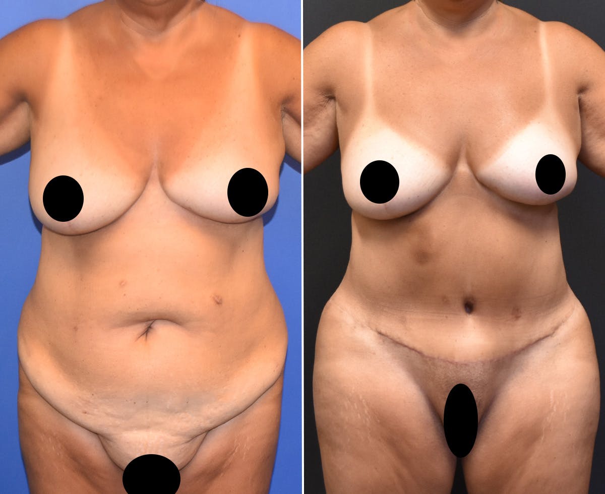 Tummy Tuck Before & After Gallery - Patient 219714 - Image 1