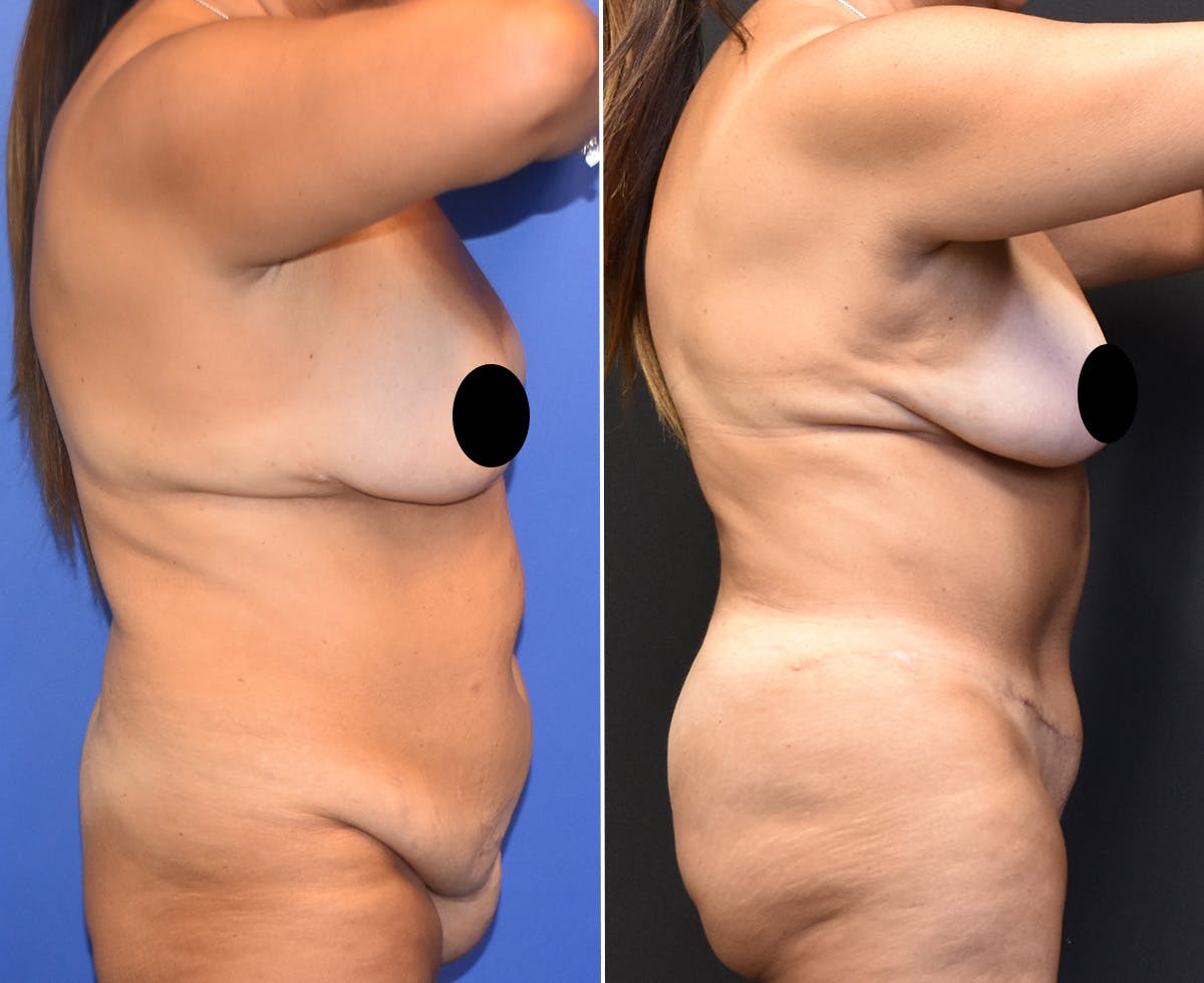 Tummy Tuck Before & After Gallery - Patient 219714 - Image 2
