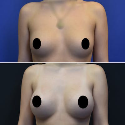 Breast Augmentation Before & After Gallery - Patient 178880 - Image 1