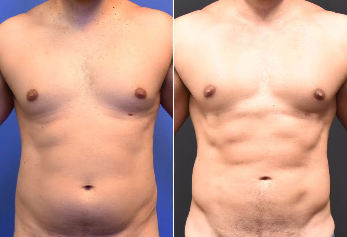 Male Liposuction Before & After Gallery - Patient 294046 - Image 1