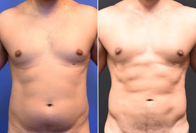 Male Liposuction Before & After Gallery - Patient 294046 - Image 1