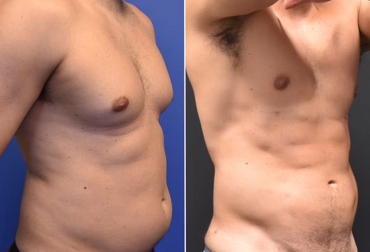 Male Liposuction Before & After Gallery - Patient 294046 - Image 2