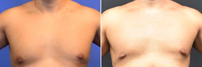 Gynecomastia Before & After Gallery - Patient 810329 - Image 1