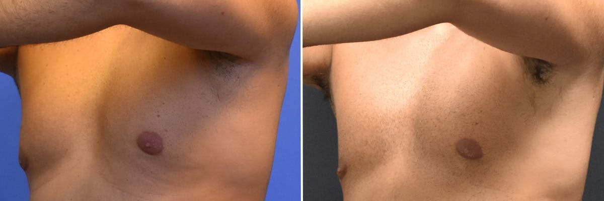 Gynecomastia Before & After Gallery - Patient 810329 - Image 2