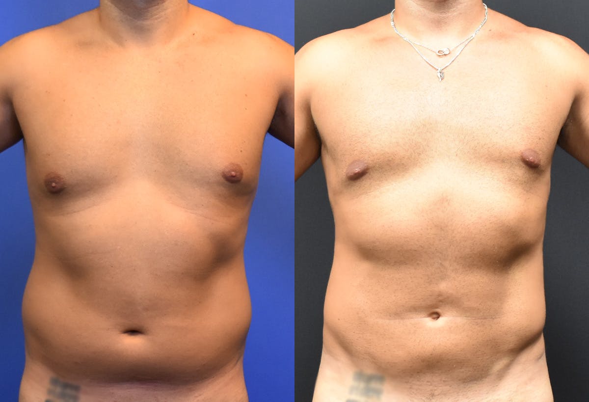 Male Liposuction Before & After Gallery - Patient 415703 - Image 1