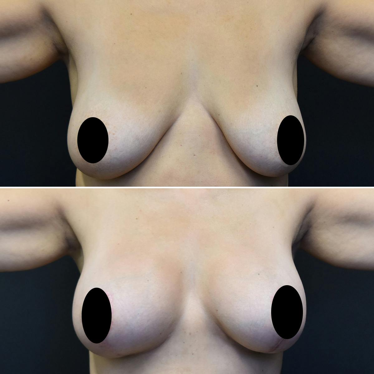 Breast Lift Before & After Gallery - Patient 106130 - Image 1