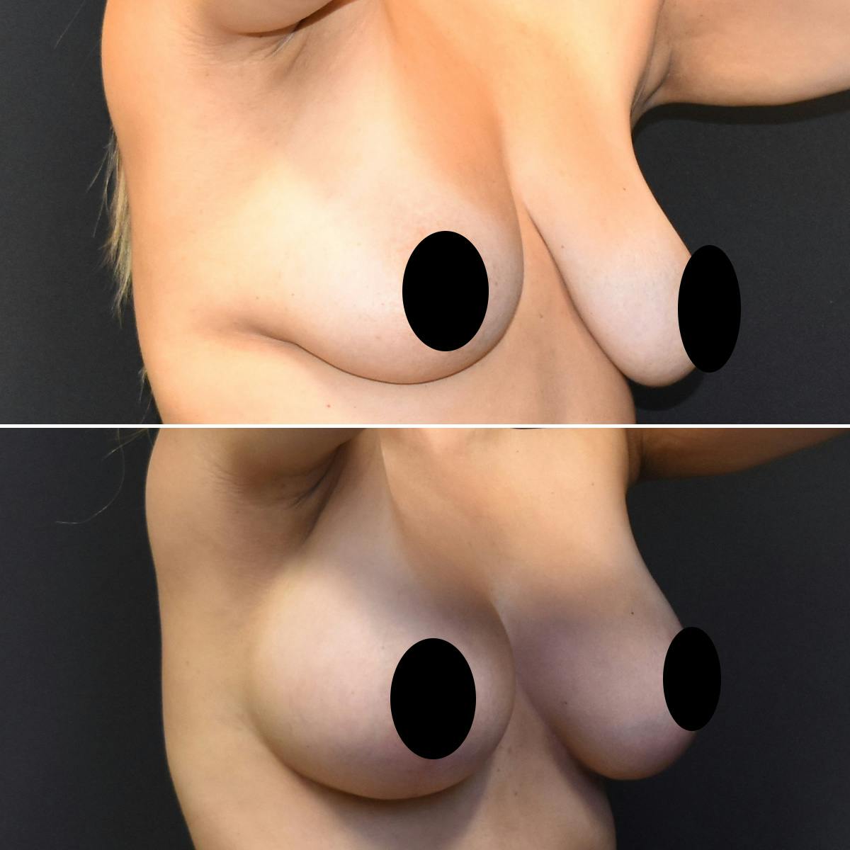 Breast Lift Before & After Gallery - Patient 106130 - Image 2