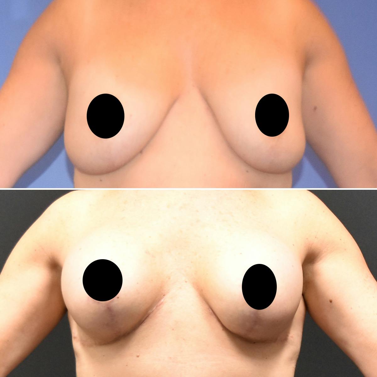 Breast Lift Before & After Gallery - Patient 249931 - Image 1
