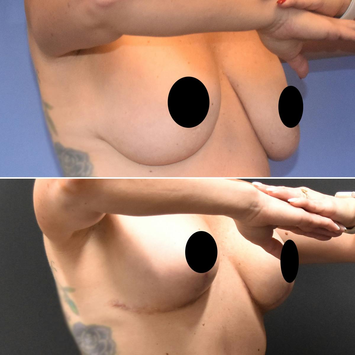 Breast Lift Before & After Gallery - Patient 249931 - Image 2