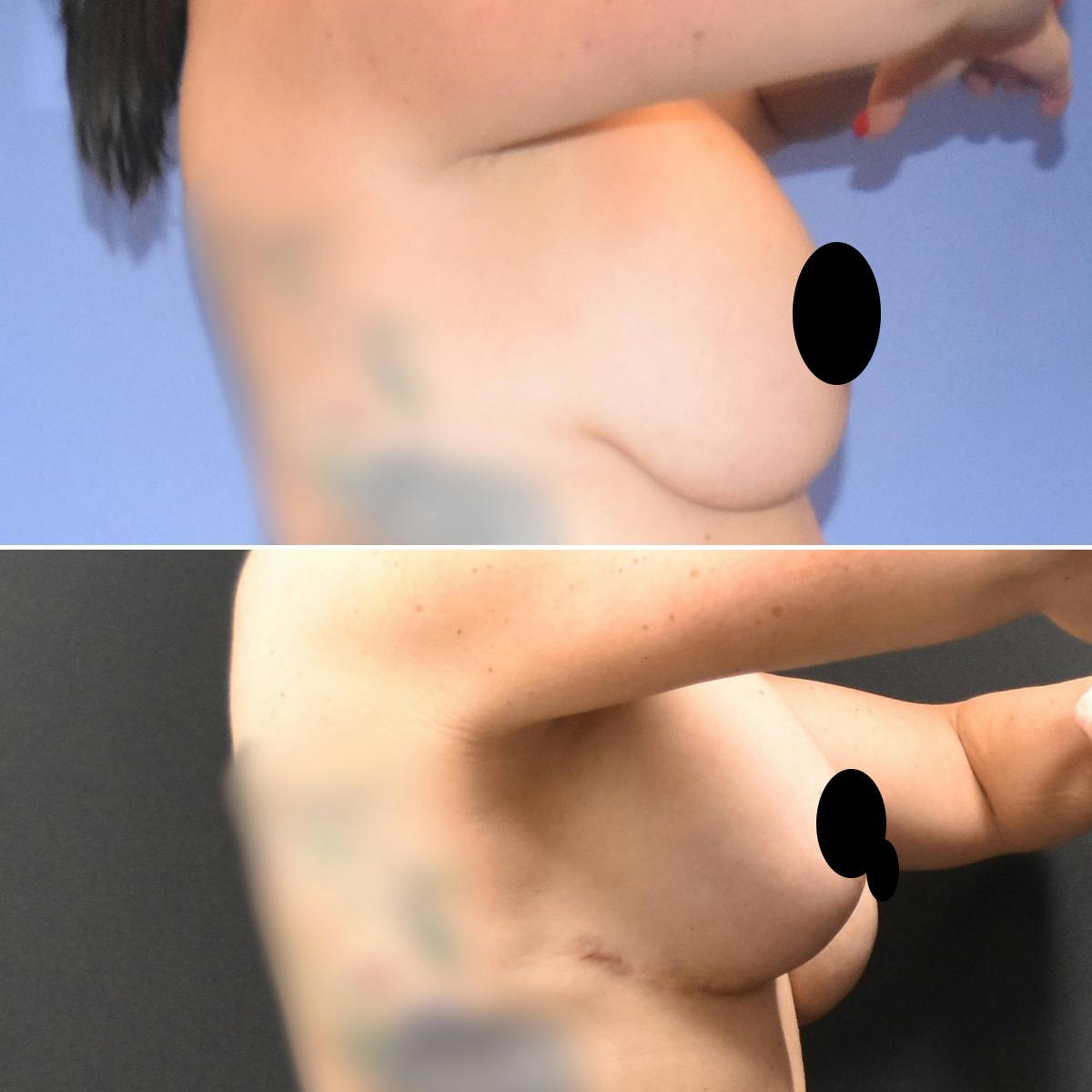 Breast Lift Before & After Gallery - Patient 249931 - Image 3