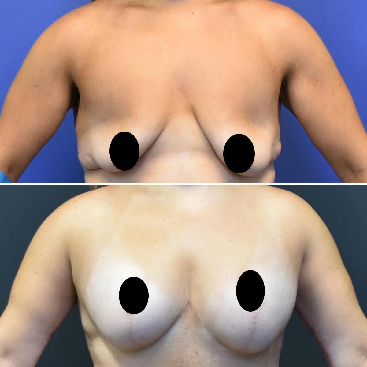 Breast Lift Before & After Gallery - Patient 300821 - Image 1