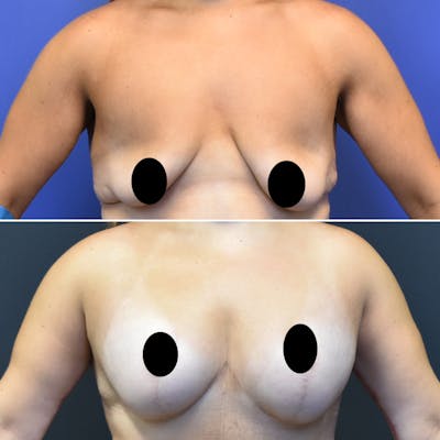 Breast Lift Before & After Gallery - Patient 300821 - Image 1