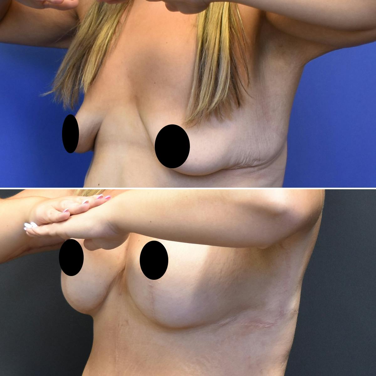 Breast Lift Before & After Gallery - Patient 300821 - Image 2