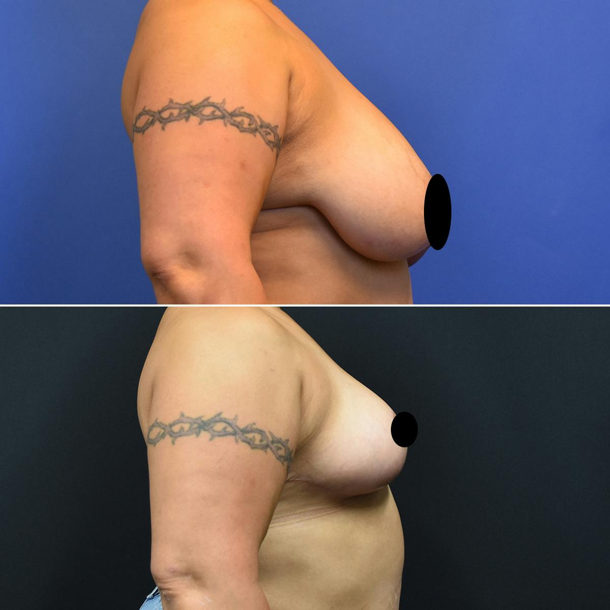 Breast Reduction Before & After Gallery - Patient 132274 - Image 3